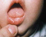 Стоматит у детей раннего возраста